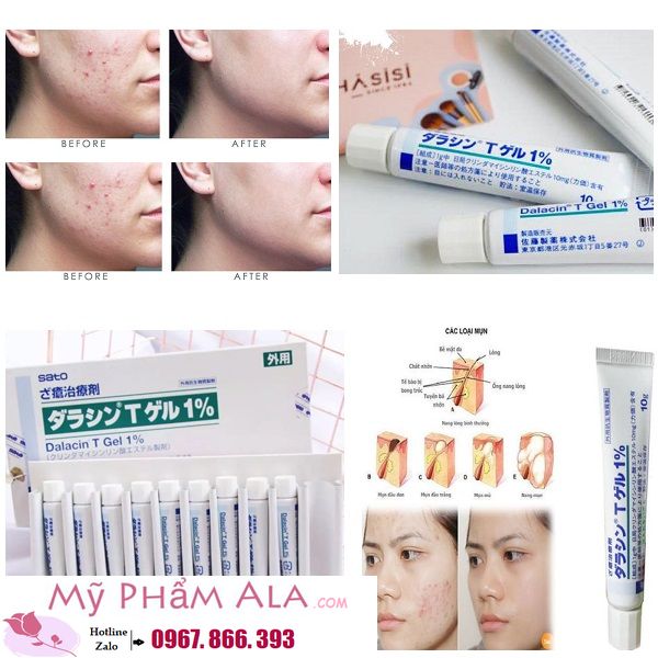 kem-tri-mun-dalacin-t-gel-1-nhat-ban-600x600